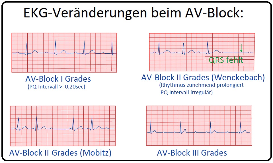 1026 EKG Veränderungen bei AV Block