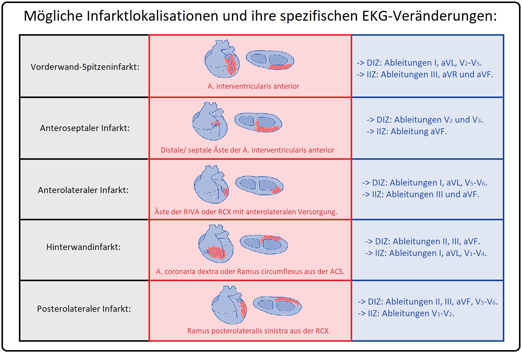 1270 Mögliche Infarktloksalisationen und ihre spezifischen EKG Veränderungen