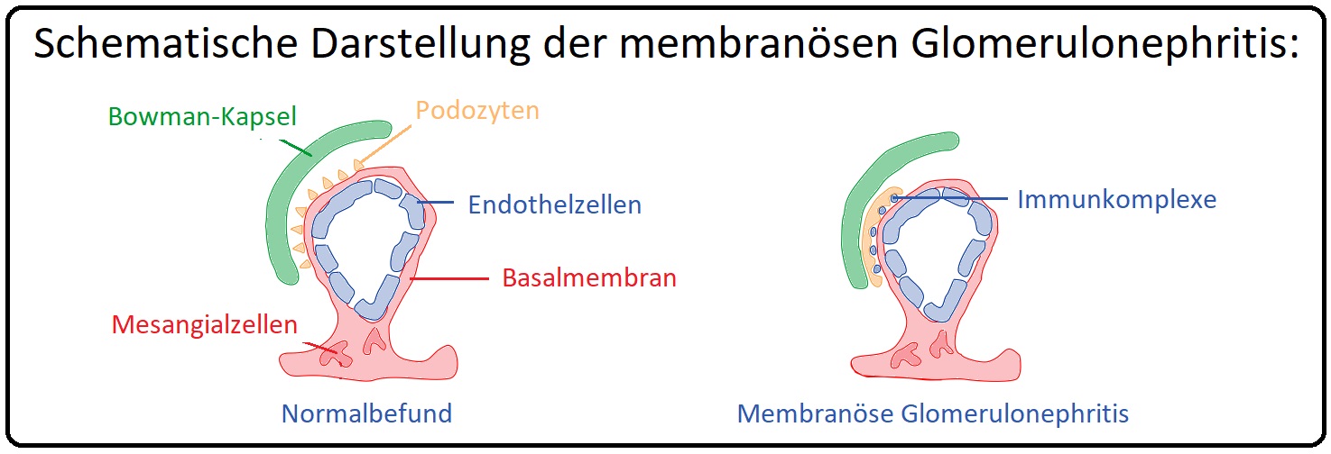 1118 Schematische Darstellung der membranösen Glomerulonephritis