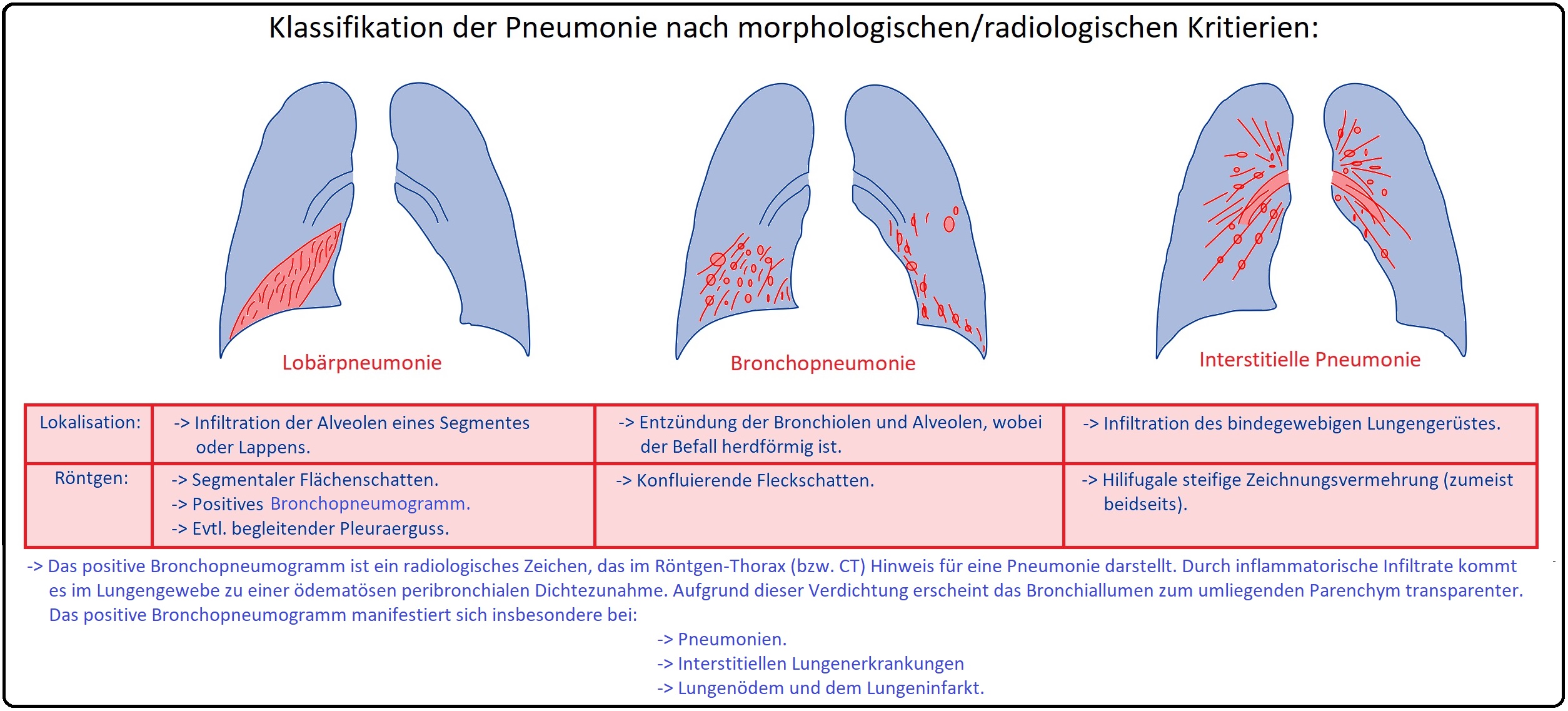 991 Klassifikation der Pneumonie nach morphologischen   radiologischen Kriterien