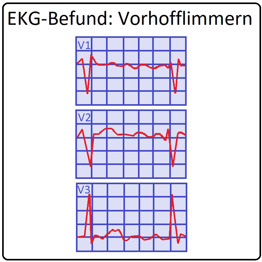 374 EKG Befund Vorhofflimmern