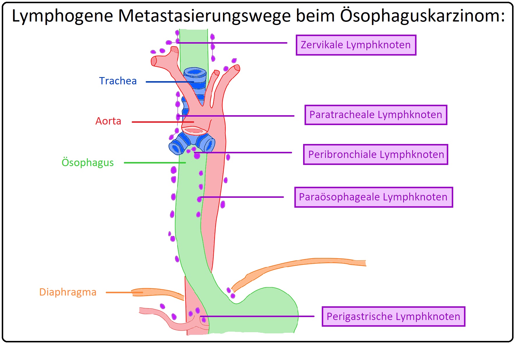 609 Lymphogene Metastasierungswege beim Ösophaguskarzinom