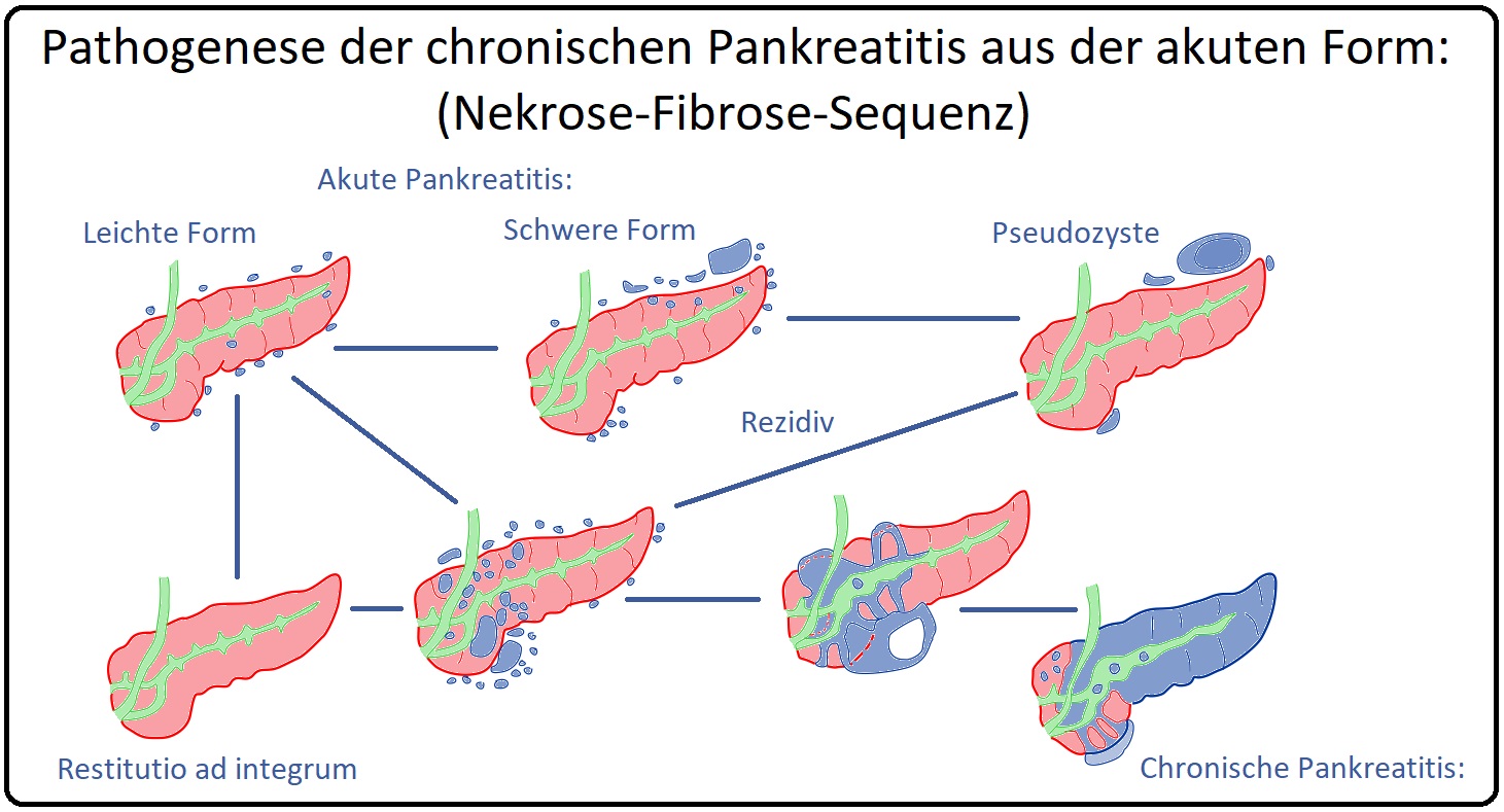 726 Pathogenese der chronischen Pankreatitis aus der akuten Form