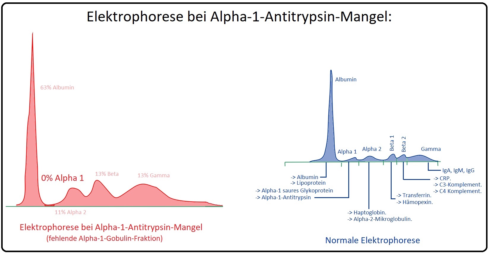 781 Elektrophorese bei Alpha 1 Antitrypsin Mangel