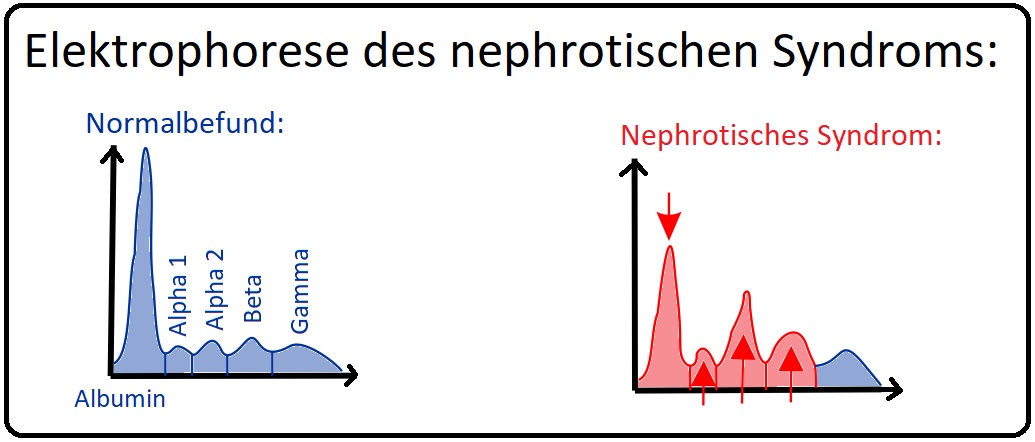 810 Elektrophorese des nephrotischen Syndroms