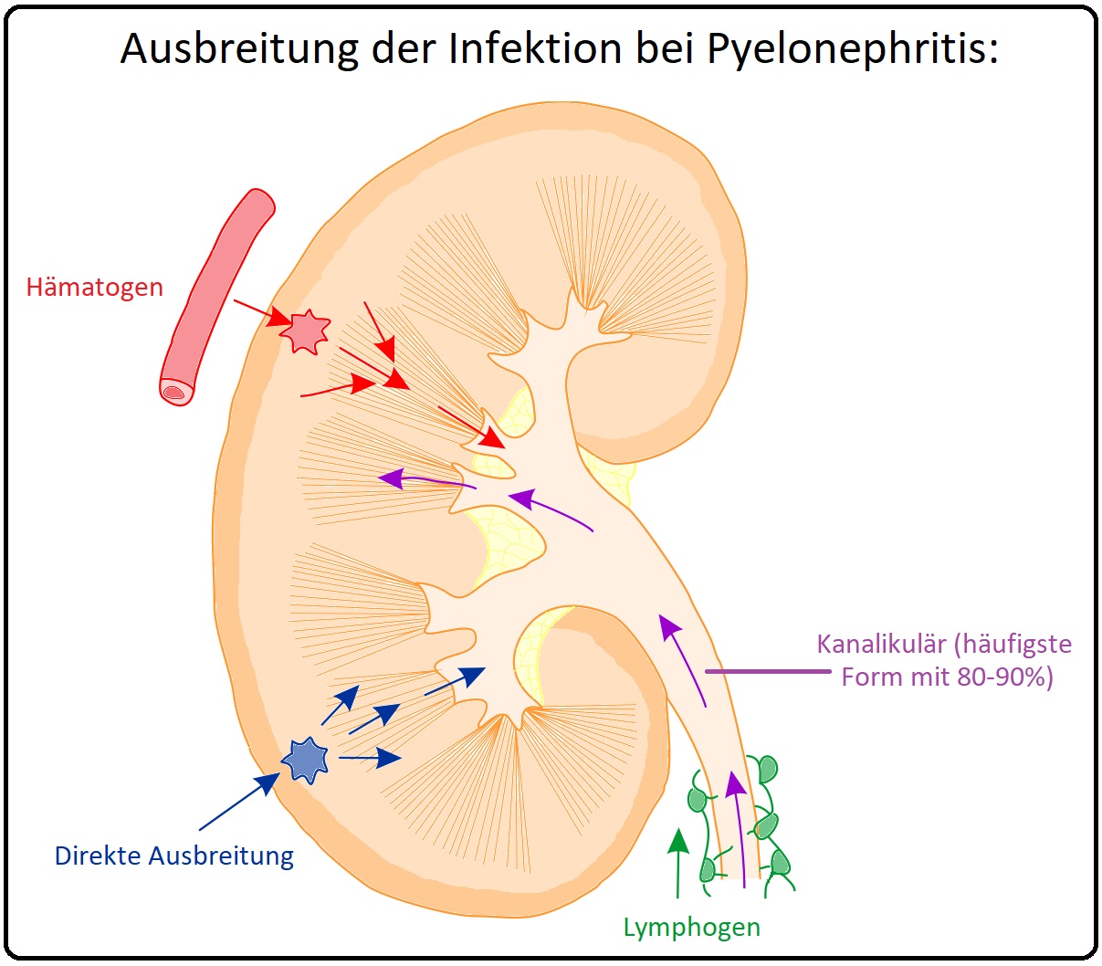 815 Ausbreitung der Infektion bei Pyelonephritis