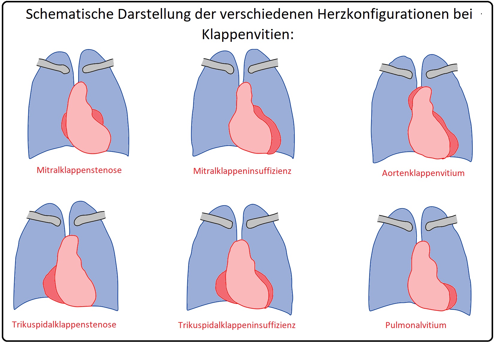830 Schematische Darstellung der verschiedenen Herzkonfigurationen bei Klappenvitien