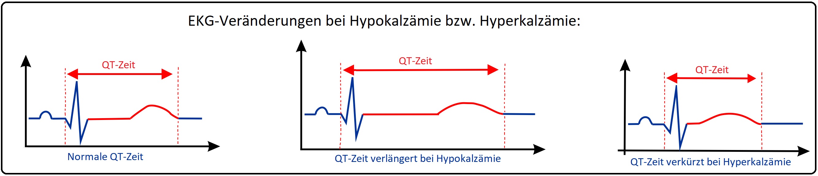 835 EKG Veränderungen bei Hypokalzämie bzw Hyperkalzämie