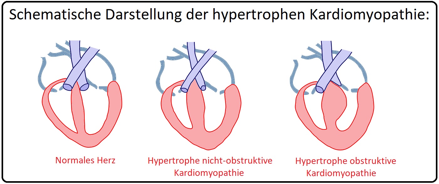 954 Schematische Darstellung der hypertrophen Kardiomyopathie