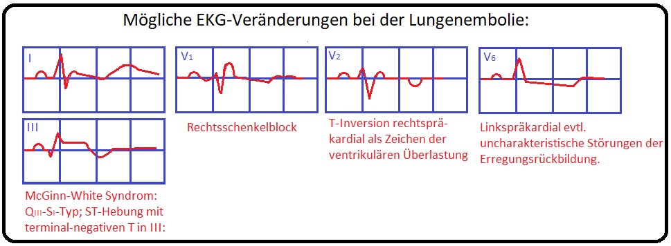 026 Mögliche EKG Veränderungen bei der Lungenembolie