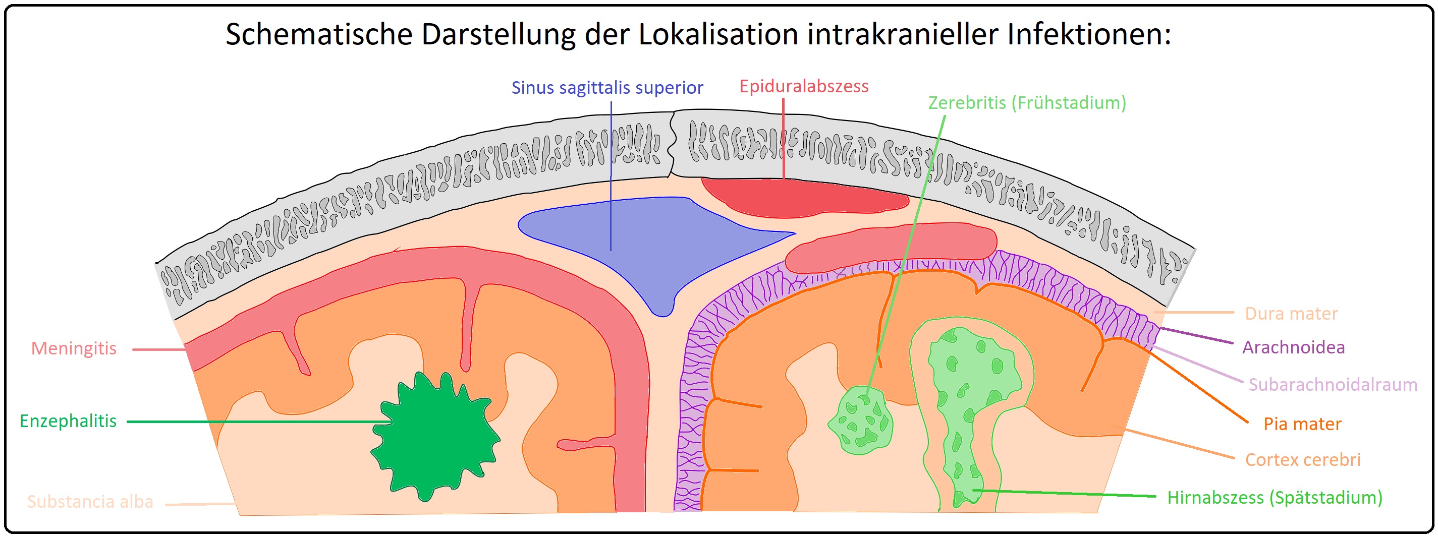 046 Schematische Darstellung der Lokalisation intrakranieller Infektionen