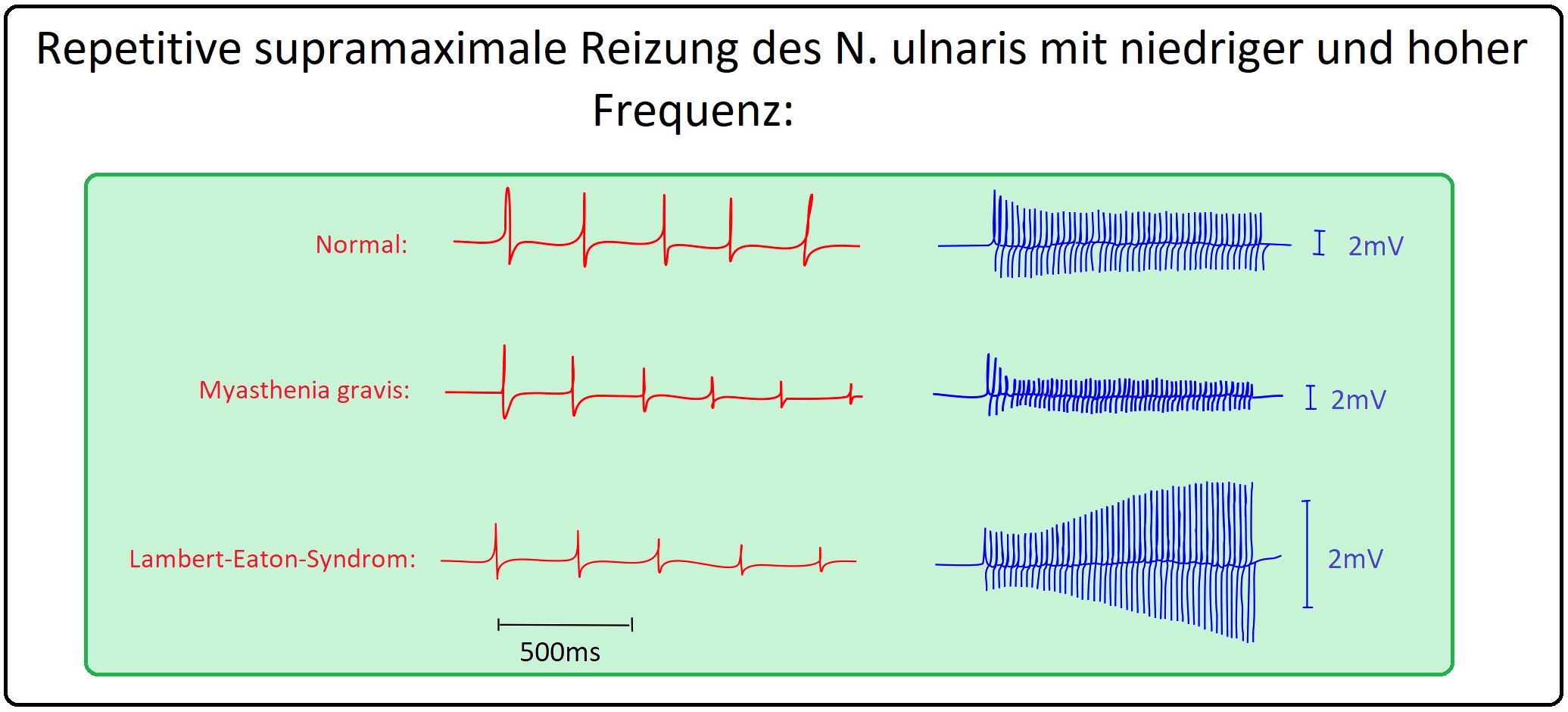 056 Repetitive supramaximale Reizung des N. ulnaris mit hoher