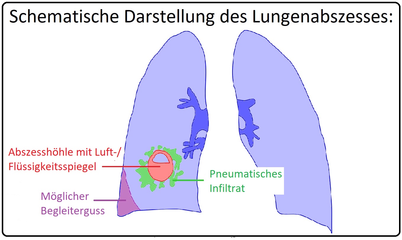 546 Schematische Darstellung des Lungenabszesses