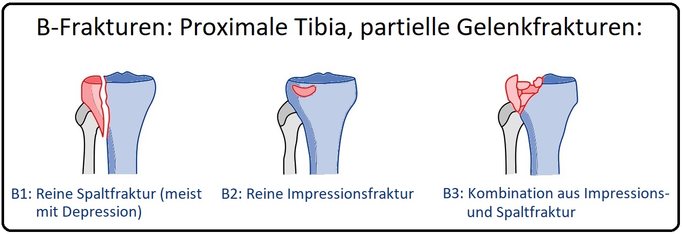 720 B Frakturen proximale Tibia partielle Gelenkfraktur